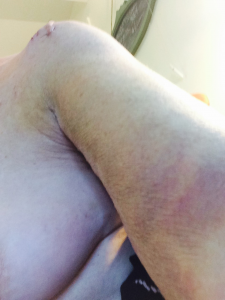 Cathy's Bruise1